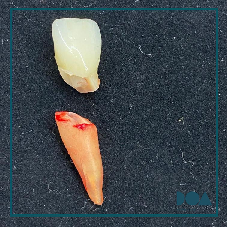 Piezas dentales o trozos después de un golpe en un diente