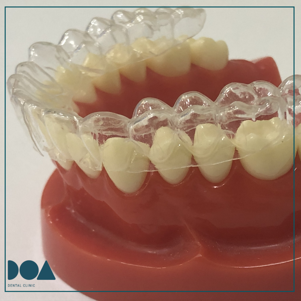 Qu Es Un Retenedor Dental Retenedores Dentales De Ortodoncia Qu Qu Es Un Retenedor Dental Retenedores Dentales De Ortodoncia Qu