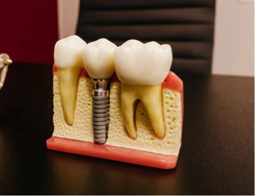 implante dental y duracion en la vida