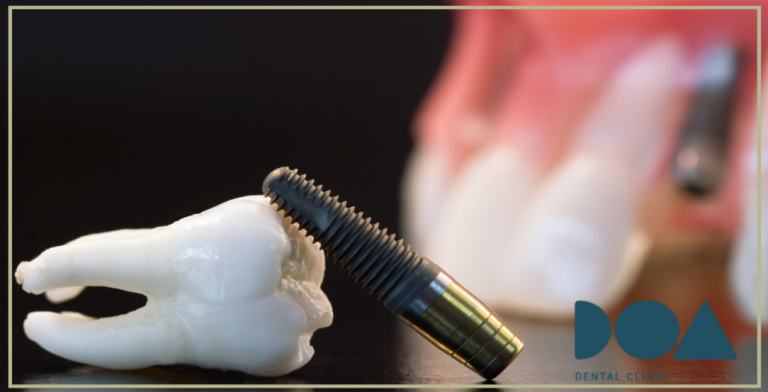 implantes son iguales
