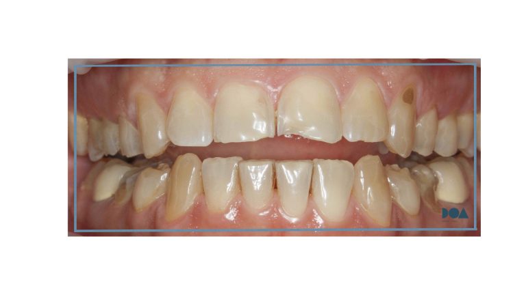 sensibilidad dental