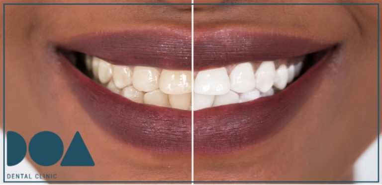 ¿qué debemos saber de los blanqueamientos dentales?