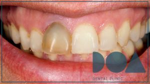 ¿qué es el blanqueamiento dental interno?
