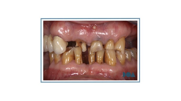 rompen los dientes
