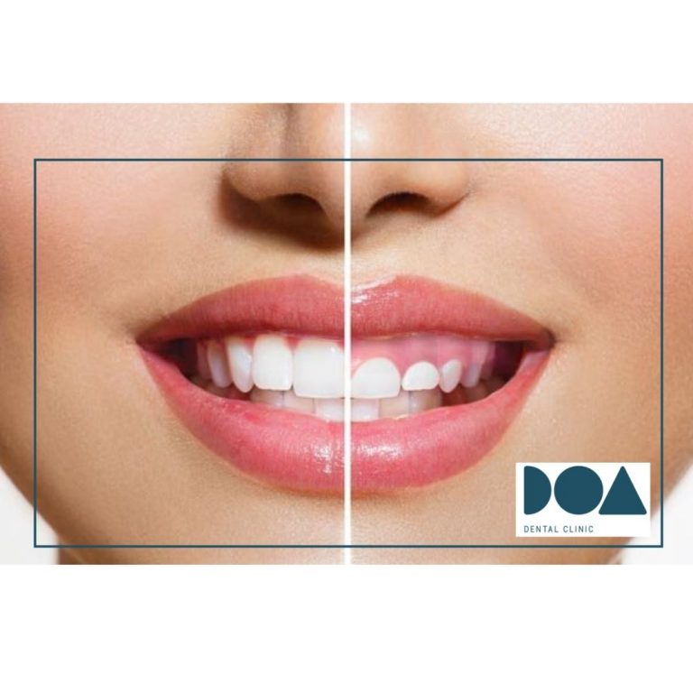 sonrisa gingival