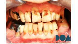 reflujo gástrico afecta dientes