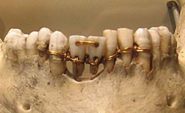 Restos arqueológicos de prótesis dentales
