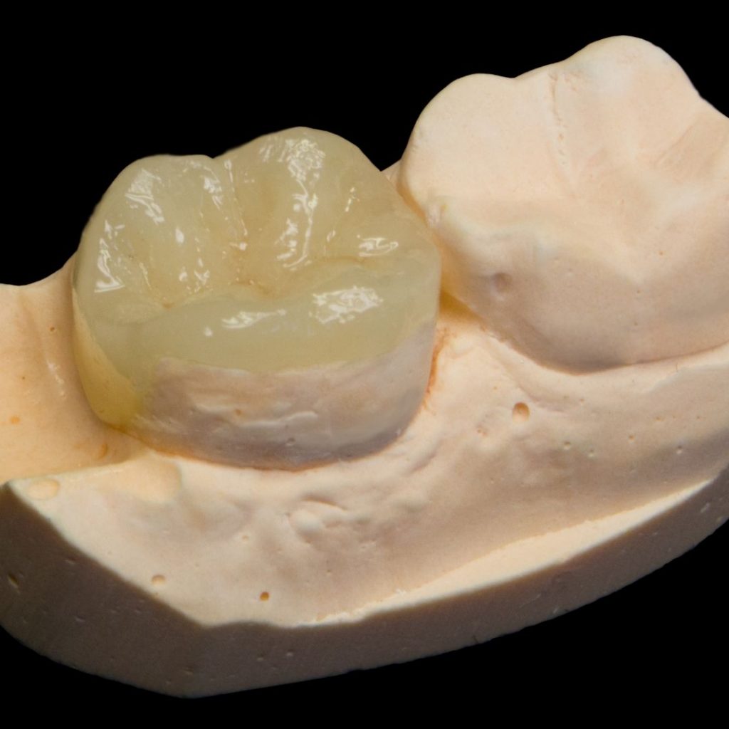 Corona parcial o incrustación, odontología mínimamente invasiva