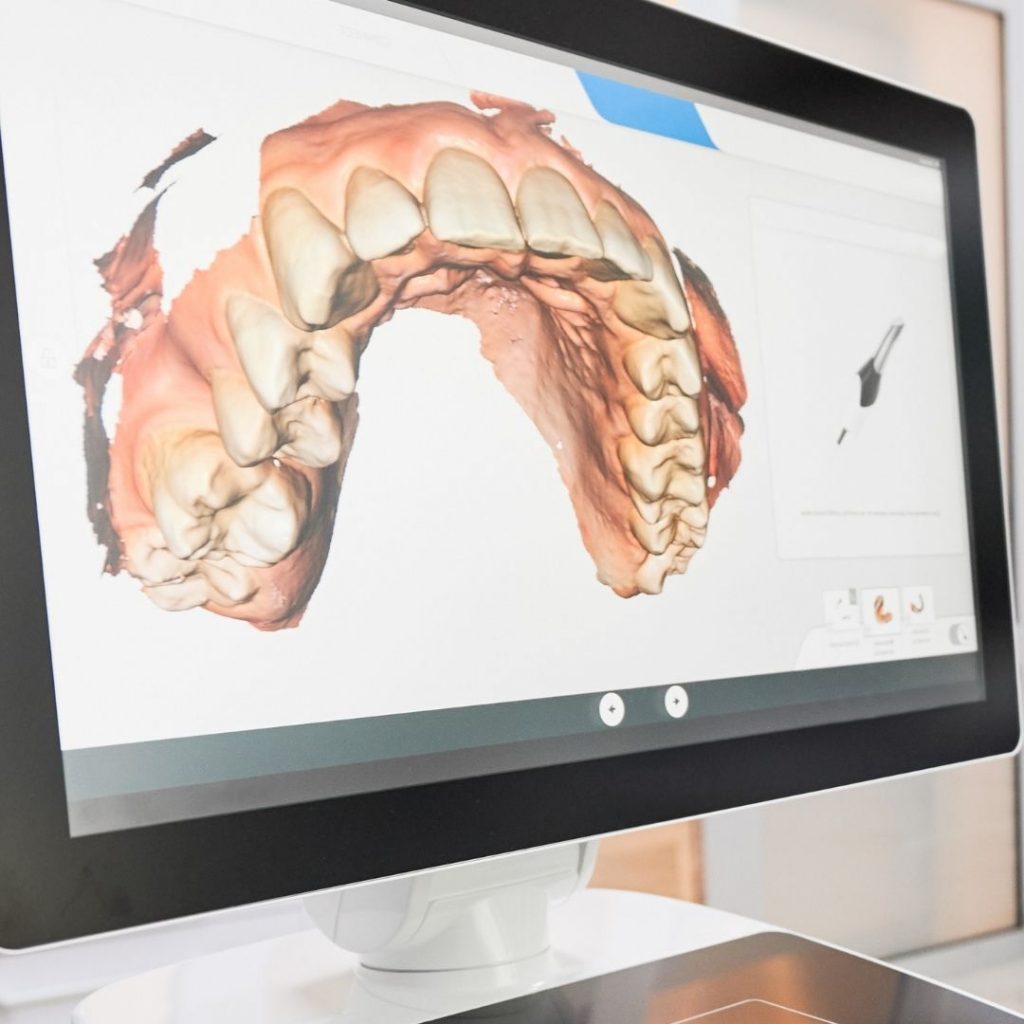 Imagen que muestra una dentadura en 3D ,odontología mínimamente invasiva