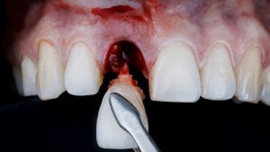 Extracción dental
