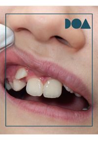 ortodoncia infantil1