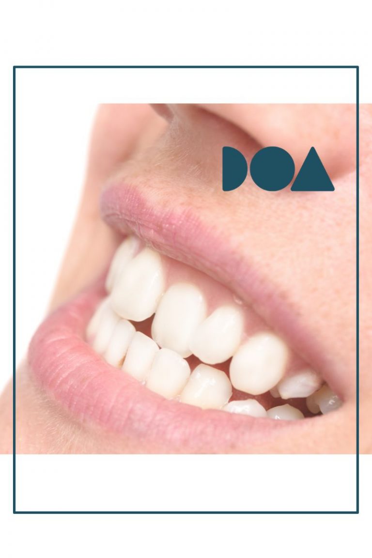alinear dientes