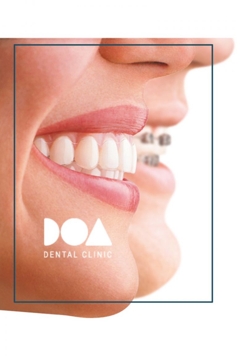 brackets o alineadores