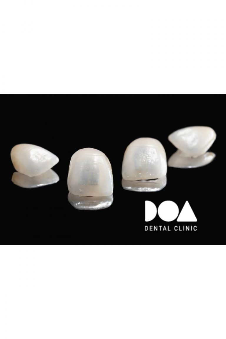 corona dental