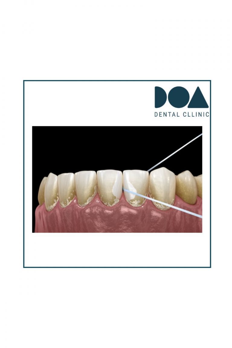 seda o hilo dental