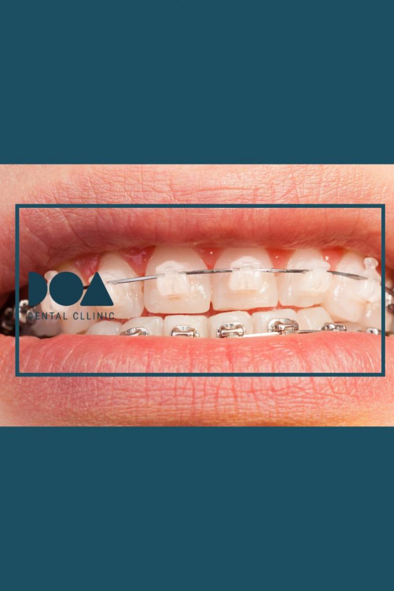 brackets estéticos o metálicos