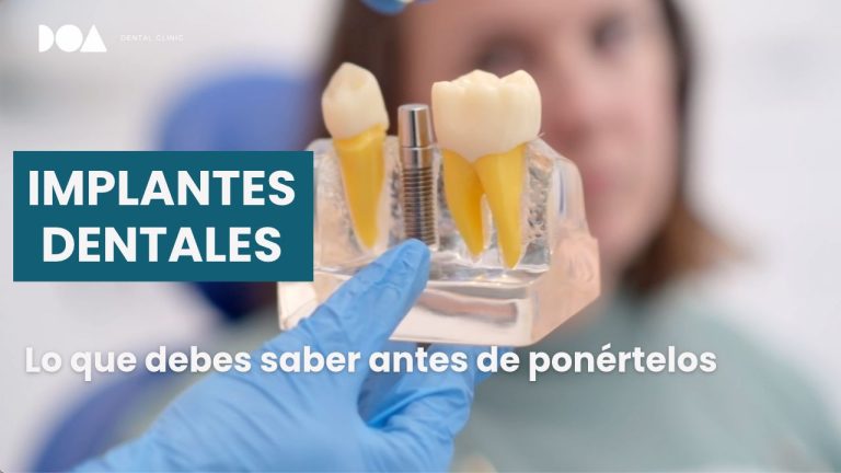 Implantes dentales: lo que debes saber antes de ponértelos